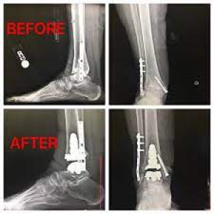 Ankle joint replacement in Iran